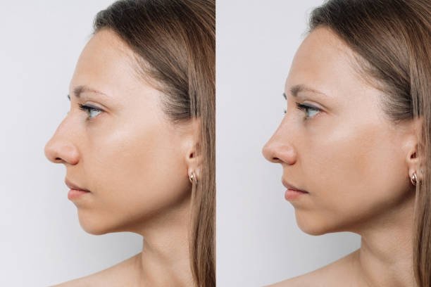 Rhinoplasty as a Confidence Booster: Riyadh’s Holistic Approach to Self-Image